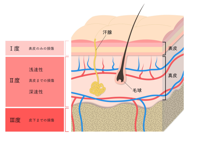 やけど（熱傷）の対応と治療 |【公式】わかば皮ふ形成クリニック広島市