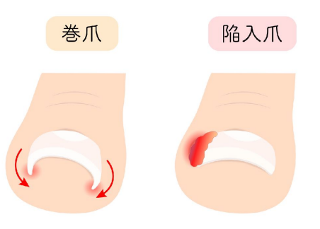 安い フェノール法 術後 サンダル