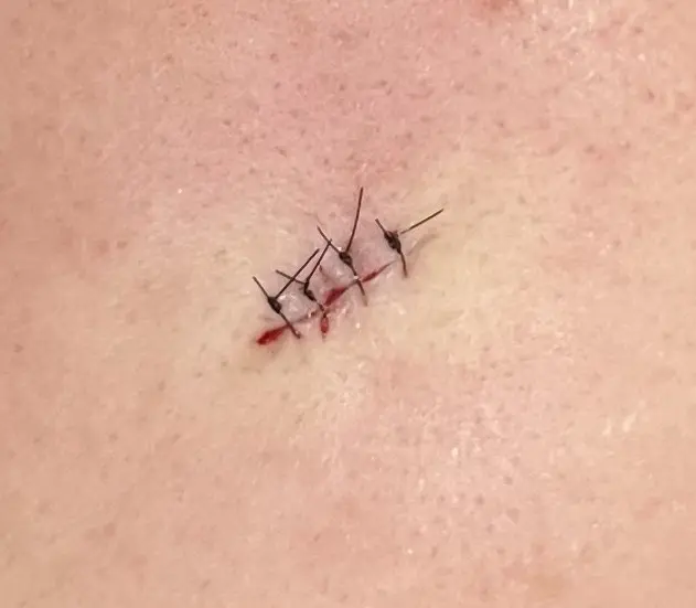 ほくろの治療（除去） |【公式】わかば皮ふ形成クリニック広島市安佐南