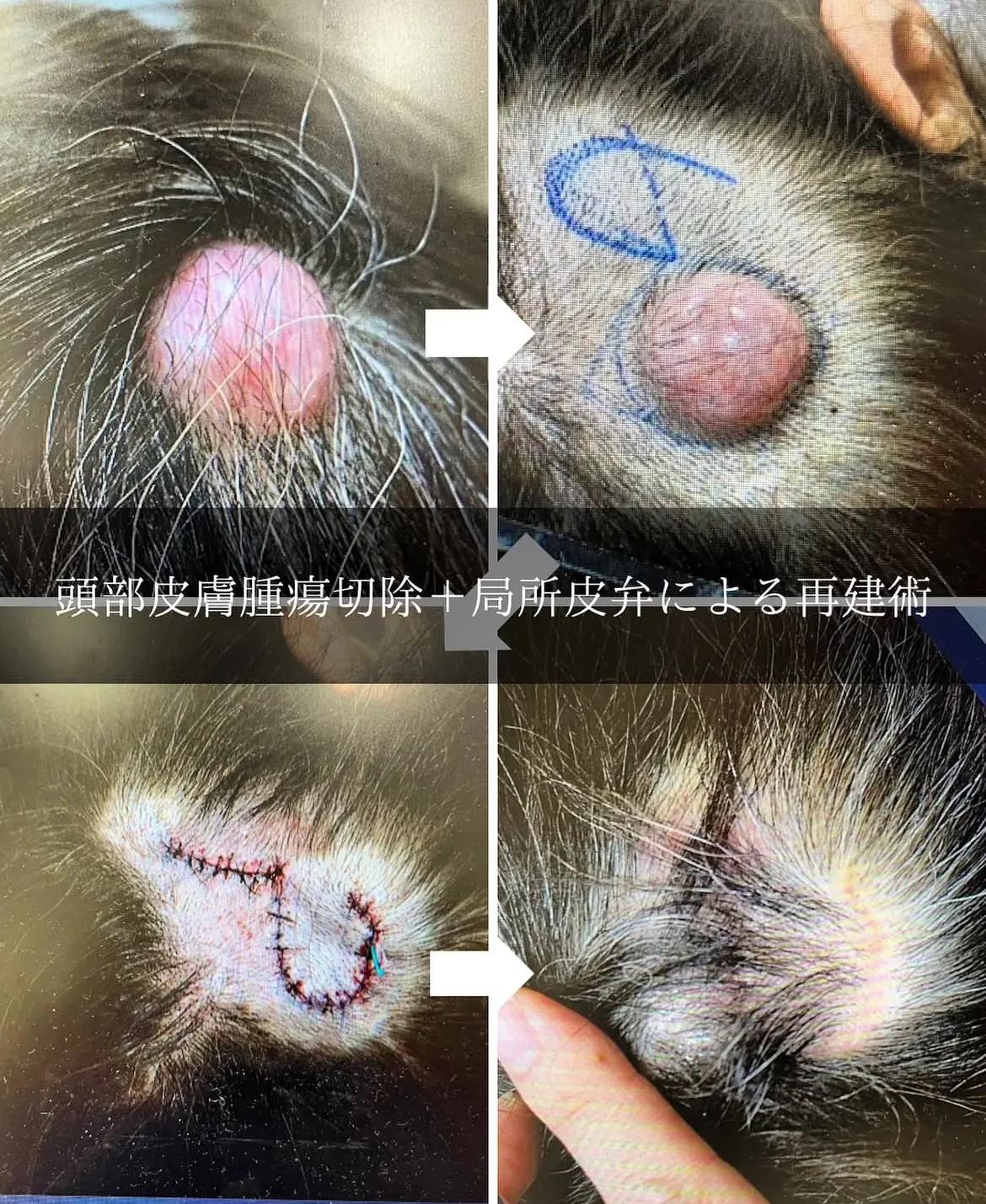 ほくろの治療（除去） |【公式】わかば皮ふ形成クリニック広島市安佐南  